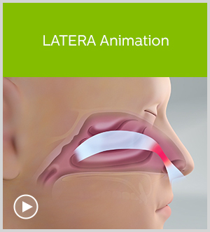 LATERA Animation